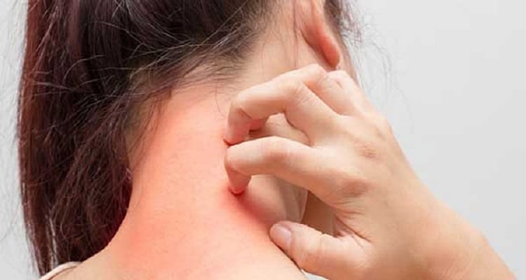 حساسية الجلد أسباب حدوثها وأعراضها وكيفية علاجها بالاعشاب صحي